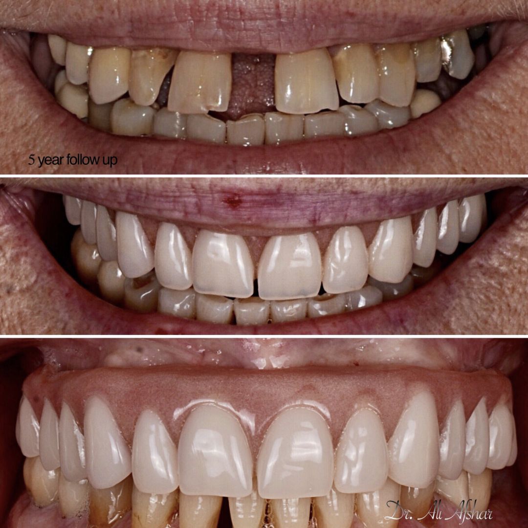 Missing teeth treatment in Edmonton