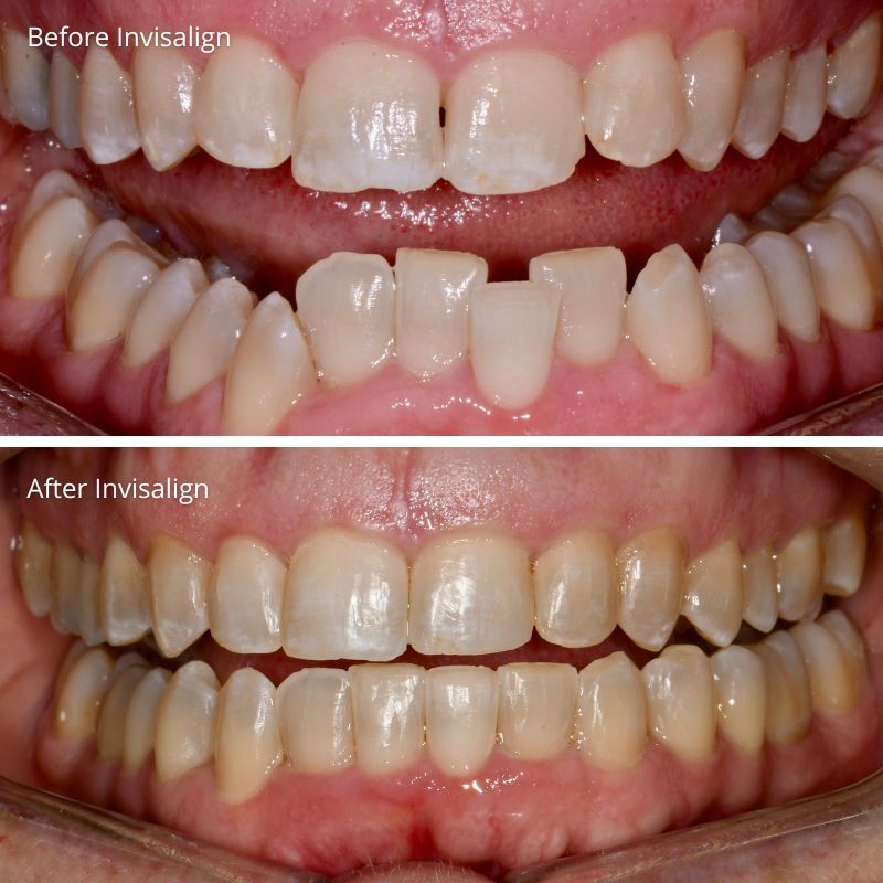 Before & After Invisalign