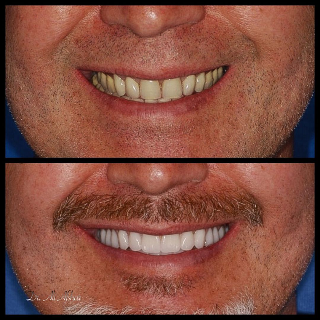 Before & After Dental implants at Princess Elizabeth Dental