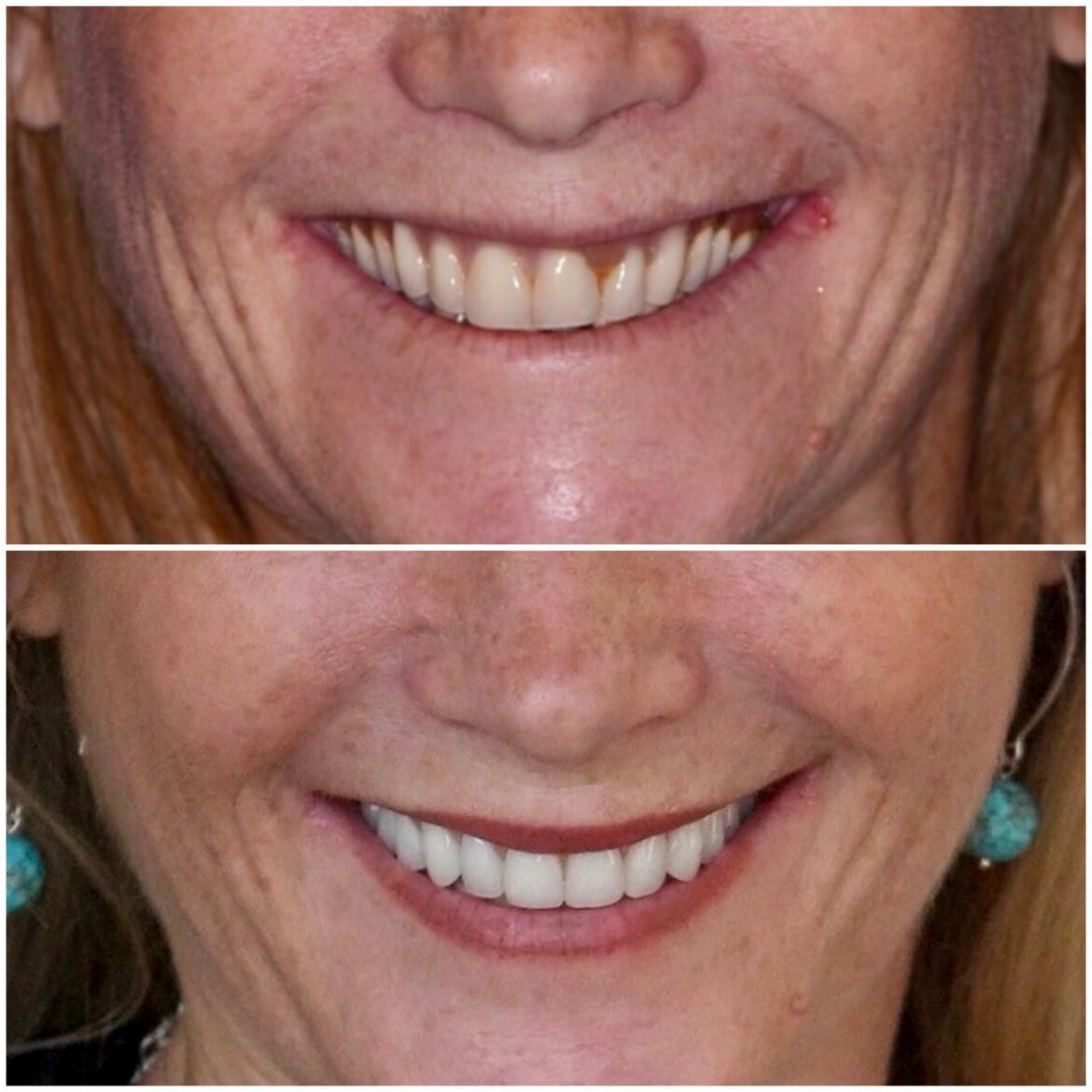 Before & After Dental implants at Princess Elizabeth Dental