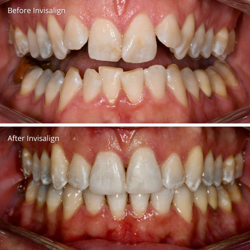 Princess Elizabeth Dental in Edmonton Invisalign Aligners