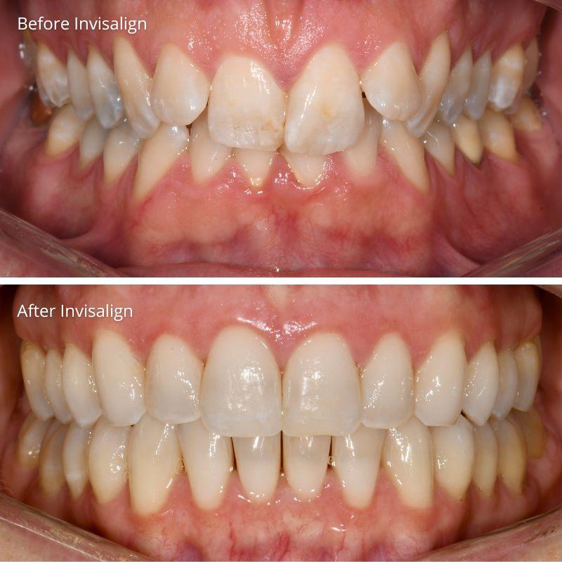 Princess Elizabeth Dental in Edmonton Invisalign Aligners