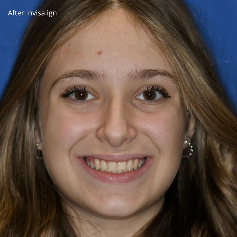 Princess Elizabeth Dental in Edmonton Invisalign Aligners