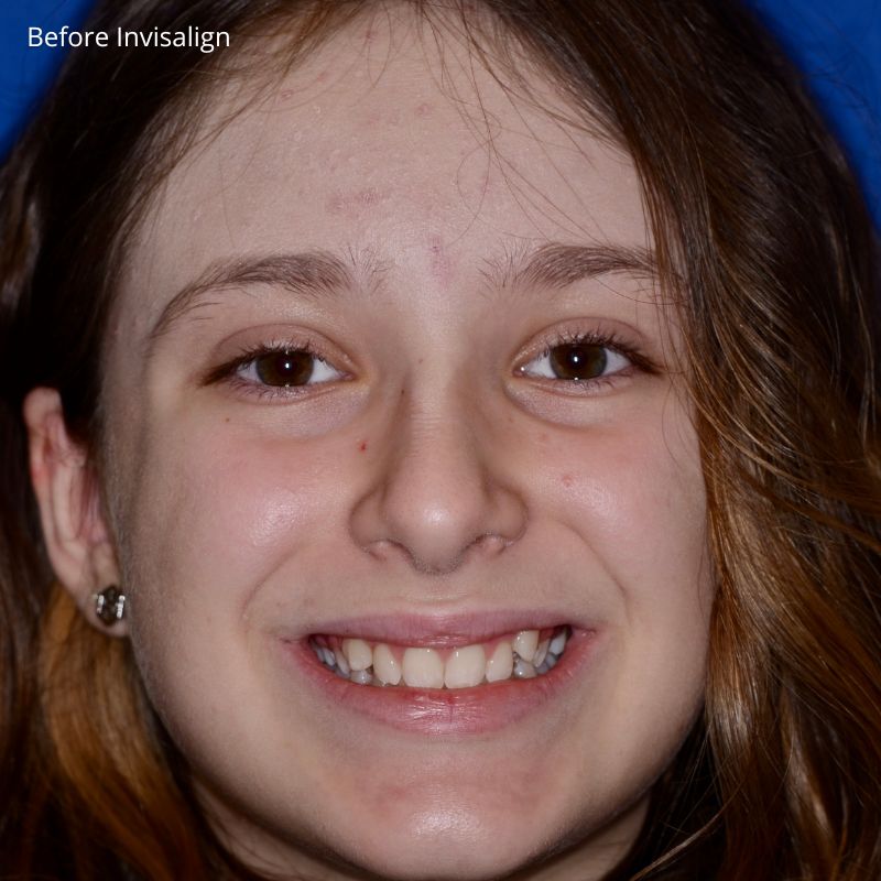 Princess Elizabeth Dental in Edmonton Invisalign Aligners