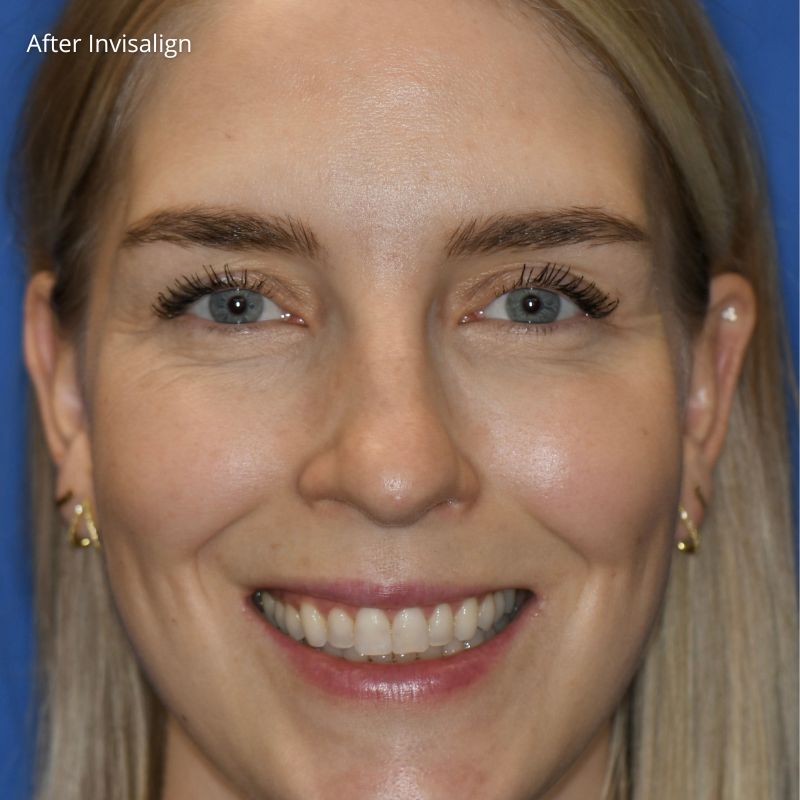 Princess Elizabeth Dental in Edmonton Invisalign Aligners