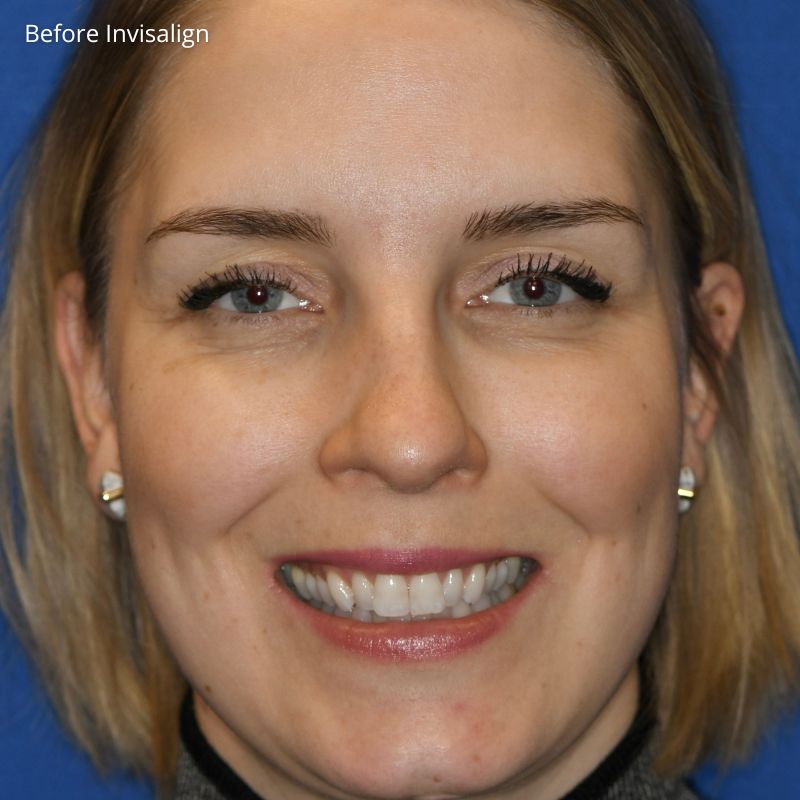 Princess Elizabeth Dental in Edmonton Invisalign Aligners