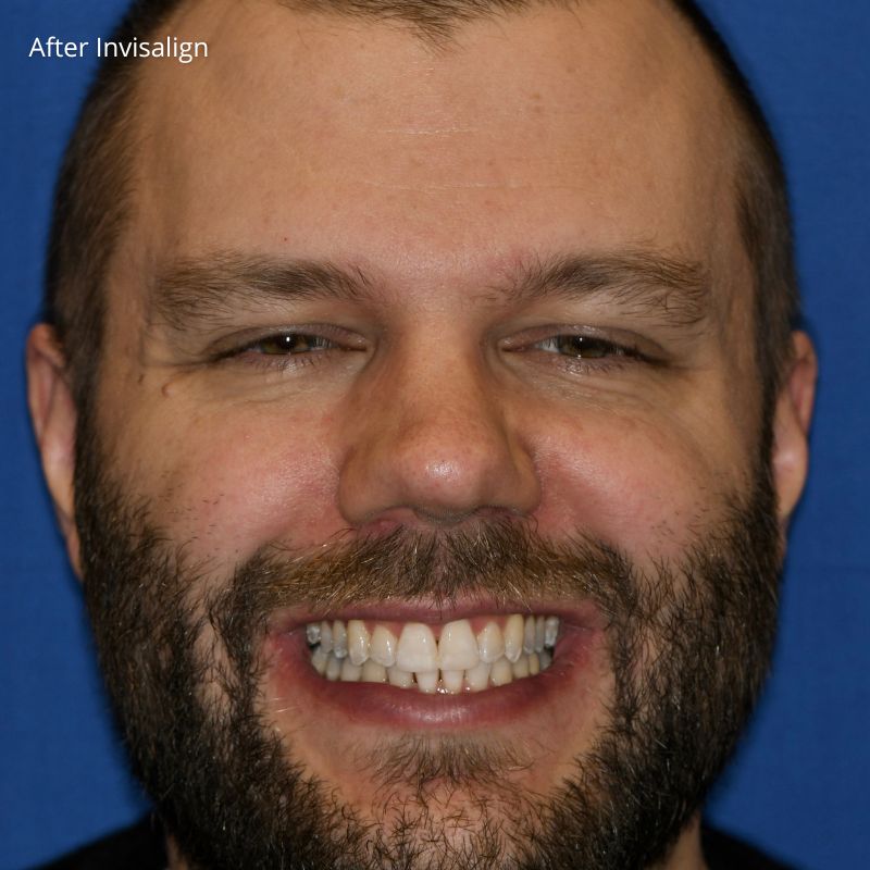 Princess Elizabeth Dental in Edmonton Invisalign Aligners