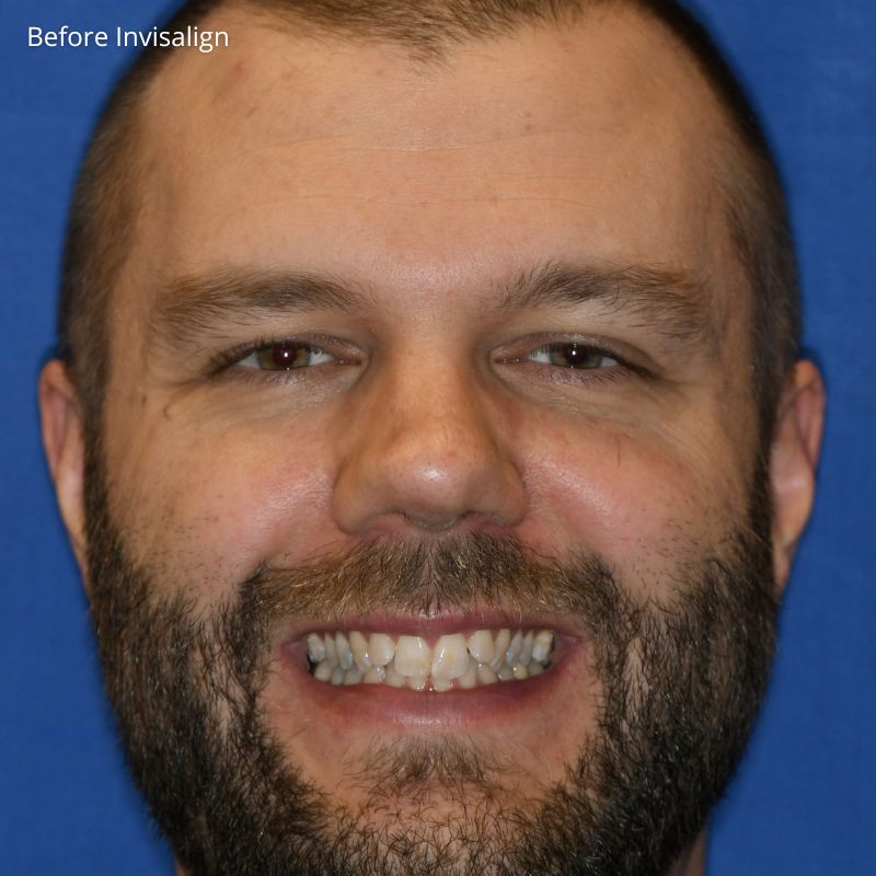 Princess Elizabeth Dental in Edmonton Invisalign Aligners