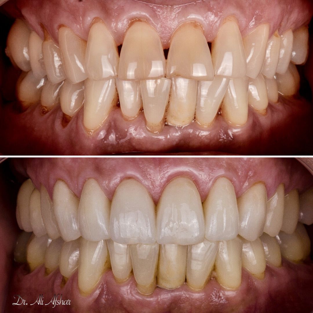 Missing teeth treatment in Edmonton