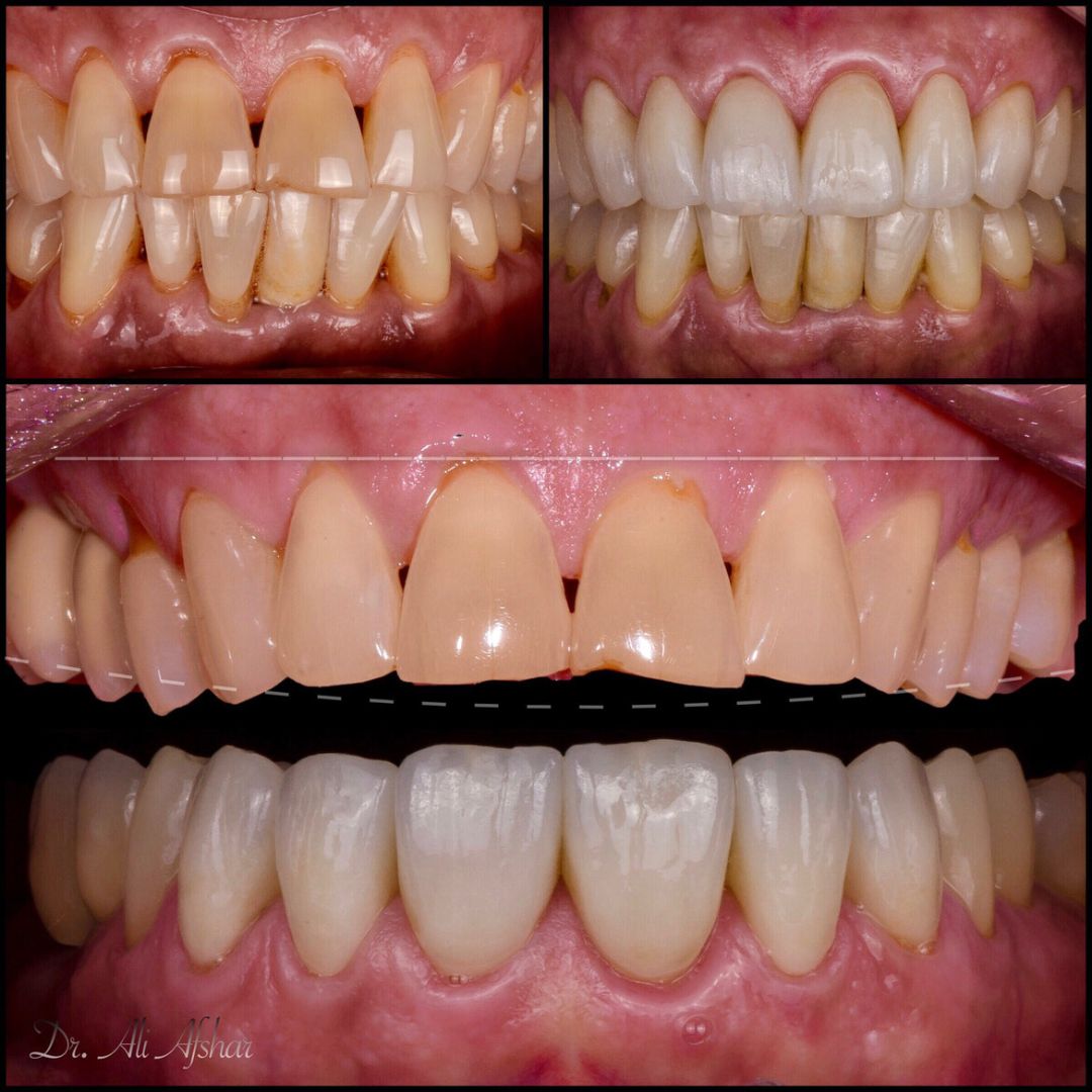 Missing teeth treatment in Edmonton