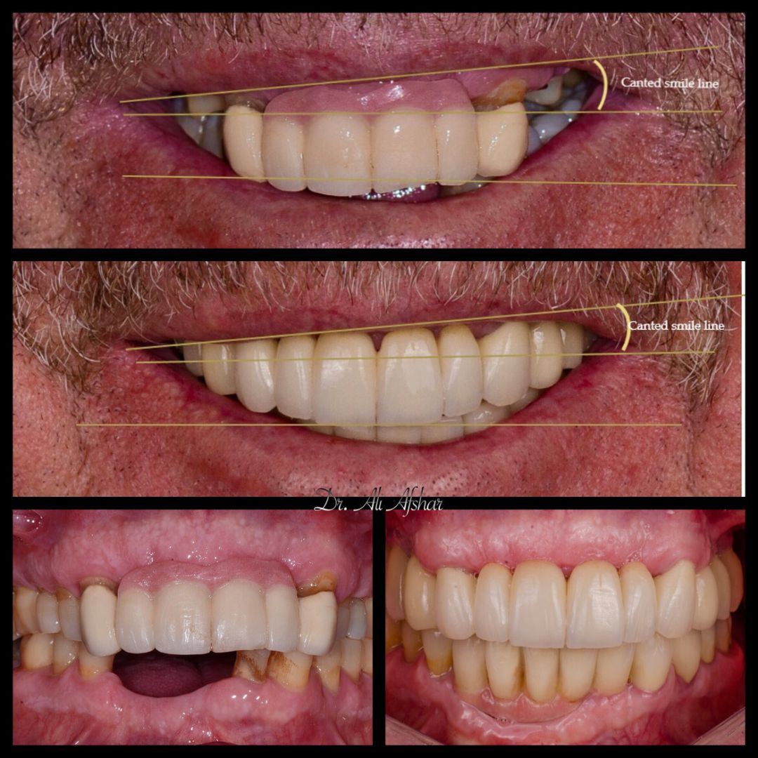 Missing teeth treatment in Edmonton