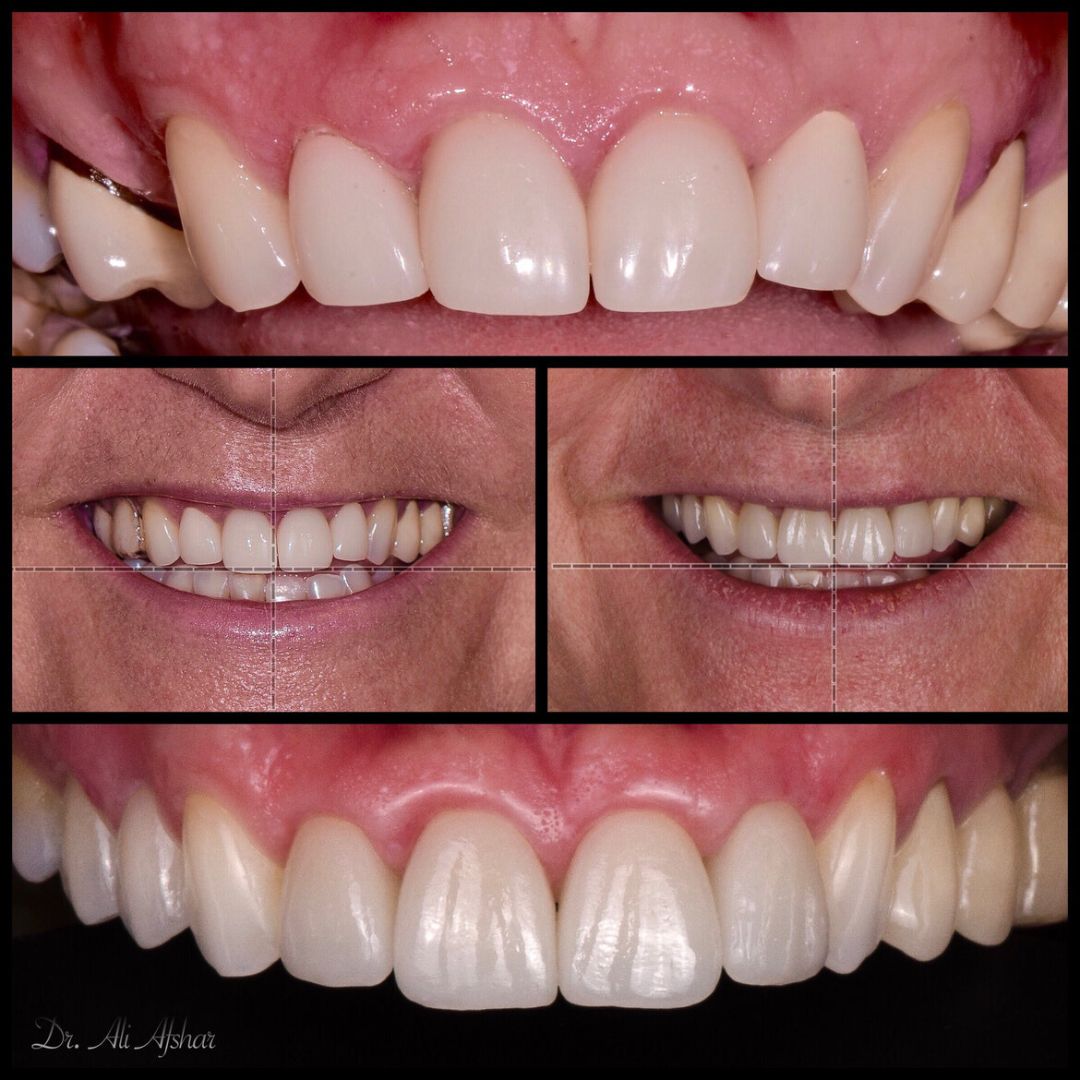 Missing teeth treatment in Edmonton